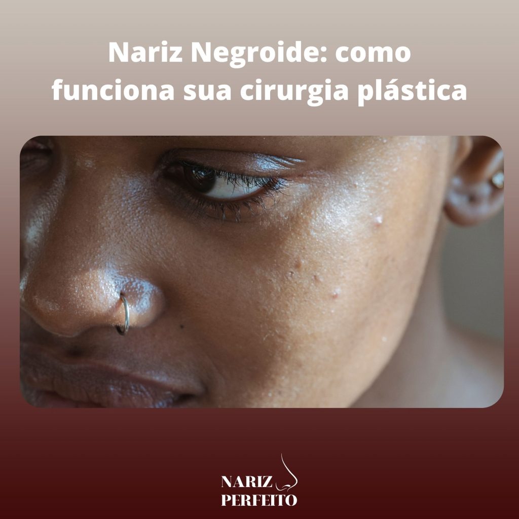 Nariz Negroide: como funciona sua cirurgia plástica