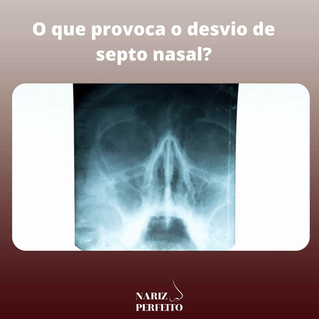 O que provoca o desvio de septo nasal?
