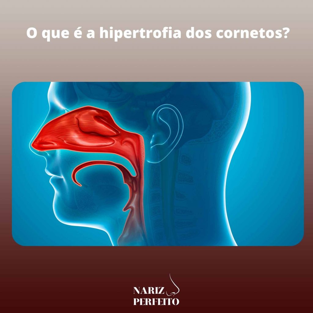 O que é a hipertrofia dos cornetos?