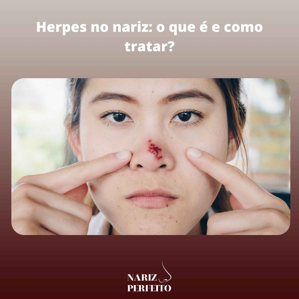 Herpes no nariz: o que é e como tratar?