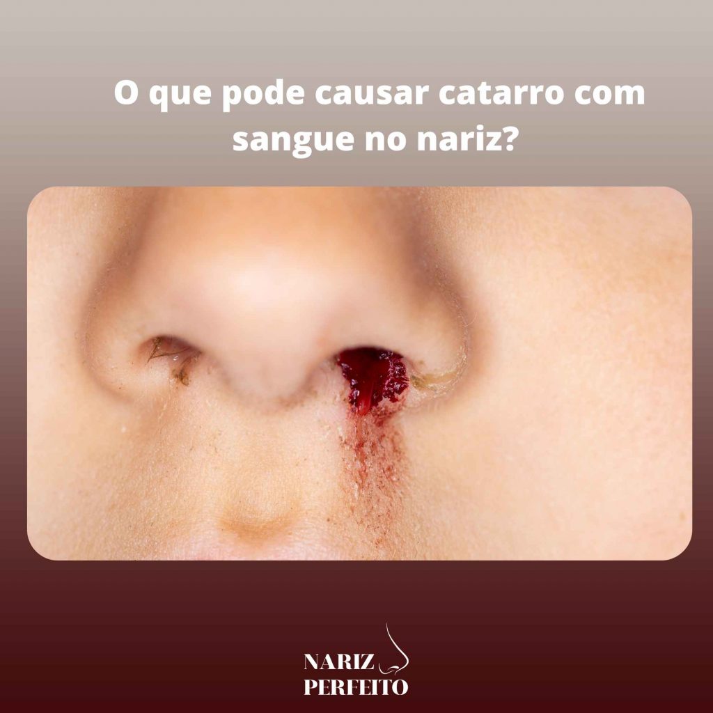 O que pode causar catarro com sangue no nariz? 