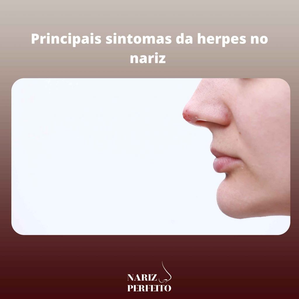 Principais sintomas da herpes no nariz 
