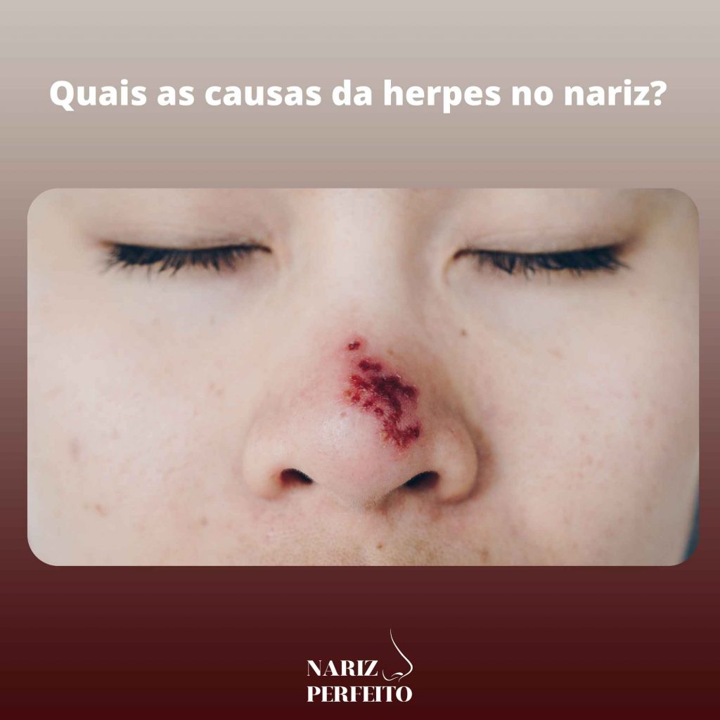 Quais as causas da herpes no nariz? 