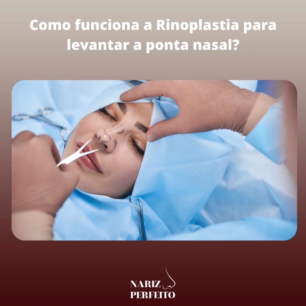 Como funciona a Rinoplastia para levantar a ponta nasal?