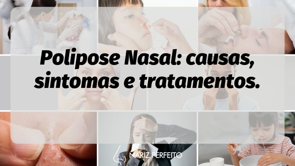 Polipose Nasal: causas, sintomas e tratamentos.