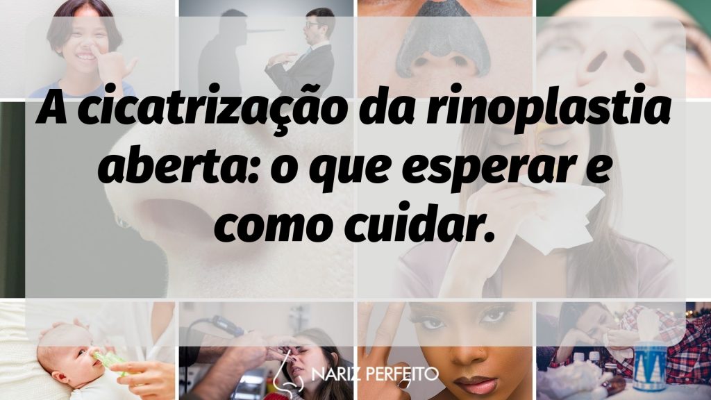 A cicatrização da rinoplastia aberta: o que esperar e como cuidar.