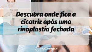 Descubra onde fica a cicatriz após uma rinoplastia fechada