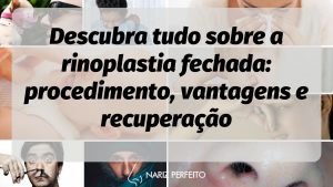 Descubra tudo sobre a rinoplastia fechada: procedimento, vantagens e recuperação