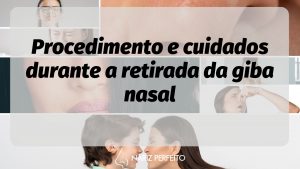 Procedimento e cuidados durante a retirada da giba nasal