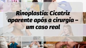 Rinoplastia: Cicatriz aparente após a cirurgia – um caso real